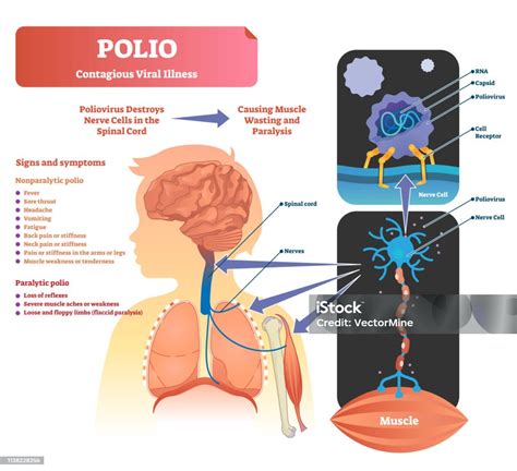 Vetores De Ilustração Do Vetor Da Pólio Esquema De Sintomas De Infecção