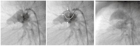 Shows Moderately Tortuous Ductus Arteriosus Pda With Three Bends