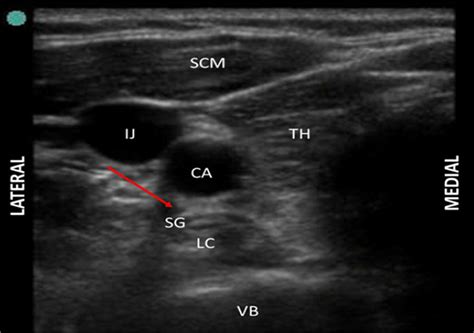 Stellate Ganglion Block Recovery