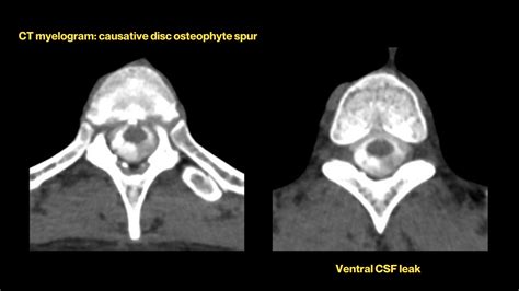 Asia Med Image 1 Spinal Csf Leak Foundation