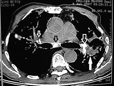 Hilar And Carinal Lymph Node Calcification Open Arrow And An Download Scientific Diagram