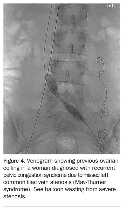 Pelvic Venous Disorders Embracing The New Svp Classification