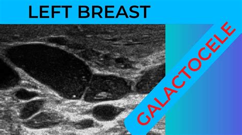 Left breast Galactocele on ultrasound Scan. - YouTube