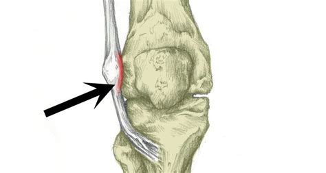 Iliotibial Band Syndrome Runners Knee Sportsinjuryclinic Net