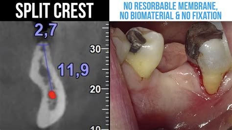 Split Crest No Resorbable Membrane No Biomaterial No Fixation