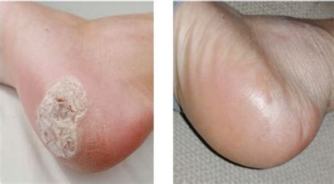 Swift Wart Therapy Rightstep Podiatry