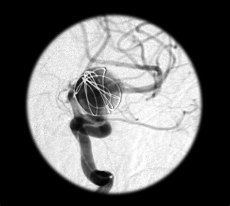 Intracranial Aneurysm Rupture Which Sex Has A Higher Rupture Risk