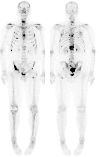 Imaging Diagnosis And Follow Up Of Advanced Prostate Cancer Clinical