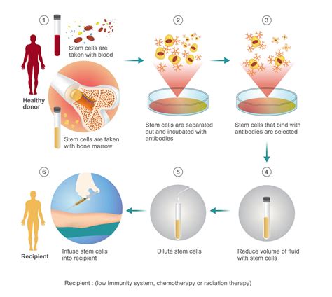 Allogeneic Bone Marrow Transplantation UniHealth Turkey