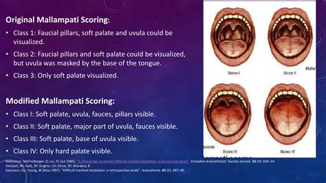 Obstructive Sleep Apnea Orthodontist S Perspective Ppt