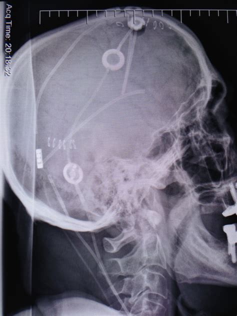 Tratamiento endoscópico de la hidrocefalia Instituto Neurocirugía