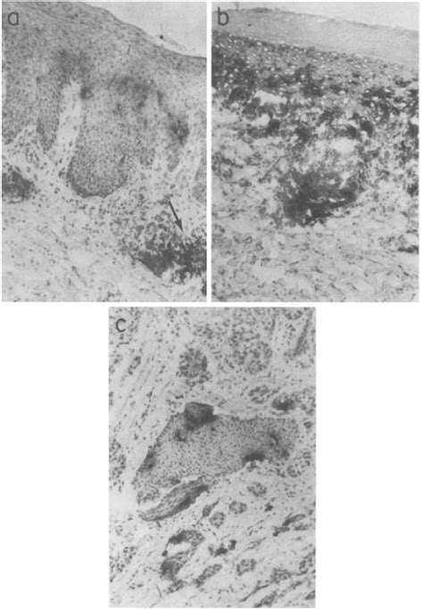 Presence Of Langerhans Cells In The Dermal Infiltrates Of Patients With