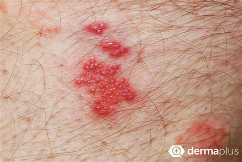 Gürtelrose Herpes Zoster Ursachen Therapie derma plus