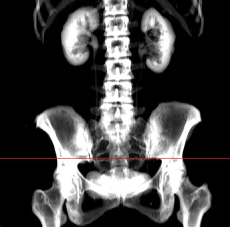 Direct Comparison Of Unenhanced And Contrast Enhanced Ct For