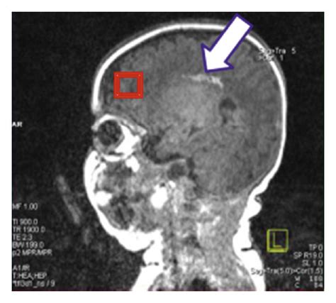 Infant’s Mri Results Reveal Periventricular Leukomalacia In Both The Download Scientific