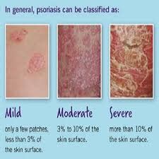 Psoriasis - Sebastopol Specialty Center