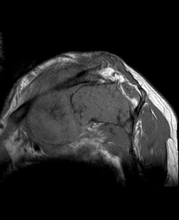 Chondrosarcoma Image Radiopaedia Org