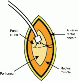 Surgical Considerations for Open Placement of Peritoneal Dialysis ...