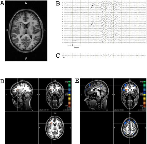 Structural Mri Eeg And Results From The Simultaneous Eeg Fmri Study