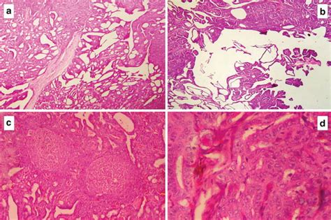 Microscopic Appearance Of Cribriform Morular Variant Of Papillary