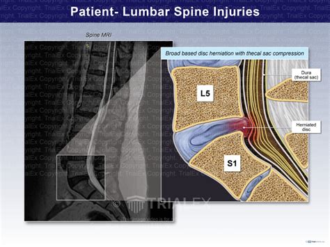 Lumbar Spine Injuries Trialquest Inc