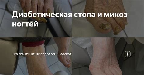 Диабетическая стопа и микоз ногтей | Leo Beauty | Центр Подологии ...