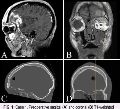 Figure From Novel Use Of An Image Guided Supraorbital Craniotomy Via