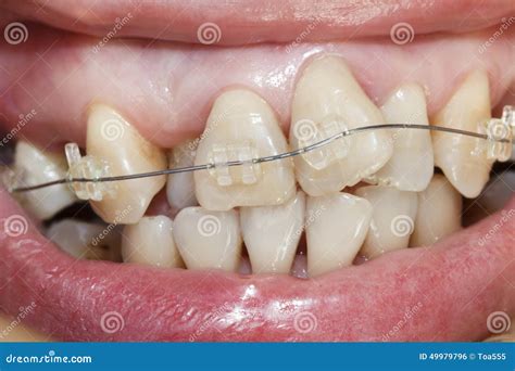 Crooked teeth with braces. stock photo. Image of beautiful - 49979796