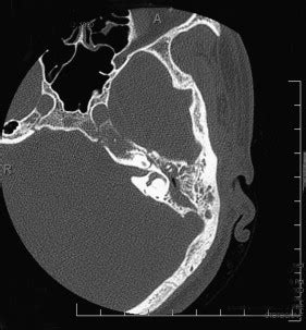 Lesions of the Petrous Apex: Diagnosis and Management | Ento Key