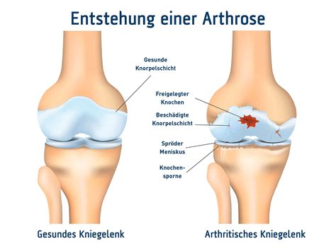 Arthrose Arten Ursachen Behandlung Mitschke Sanit Tshaus