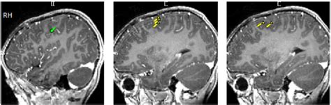 Magnetoencephalography Images Yellow Arrows Indicate Interictal