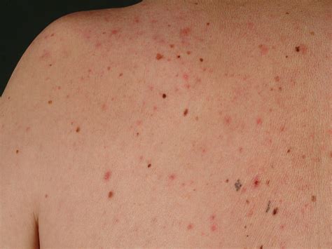 Pityrosporum Folliculitis Chest