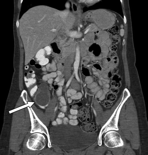 Predicting Underlying Neoplasms In Appendiceal Mucoceles At Ct Focal