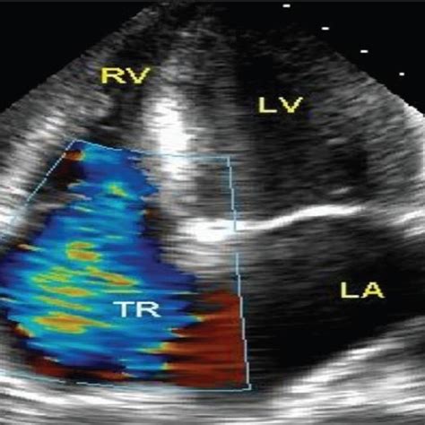 Tricuspid Regurgitation On Echocardiography Download Scientific Diagram