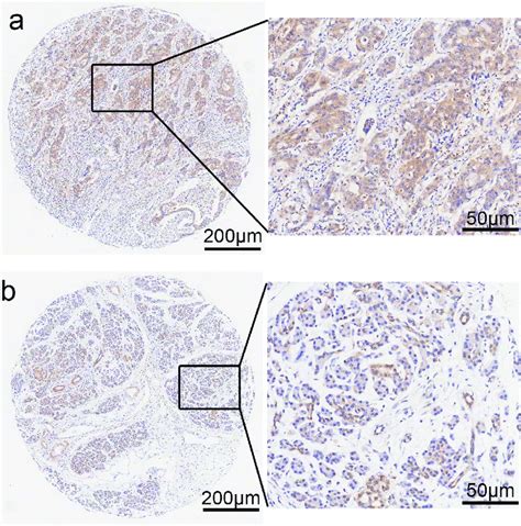 Photomicrographs Of Immunohistochemical Staining For Ppp Cb In Paad