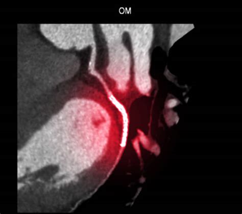 Obtuse Marginal Artery Stock Photos Pictures And Royalty Free Images