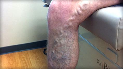 Varicose Veins Spider Or Reticular Veins Peripheral Vascular Disease