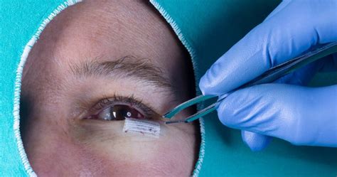 What Is Lower Eyelid Retraction Surgery 2025