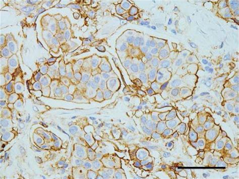 Immunohistochemistry Of Invasive Micropapillary Components A Small