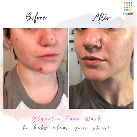 Glycolic Acid Before and After : Transformative Skincare – Touch Skin Care