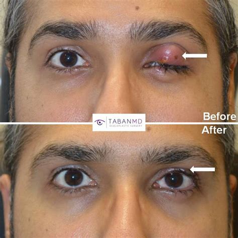 Chalazion Removal Beverly Hills Stye Surgery Los Angeles