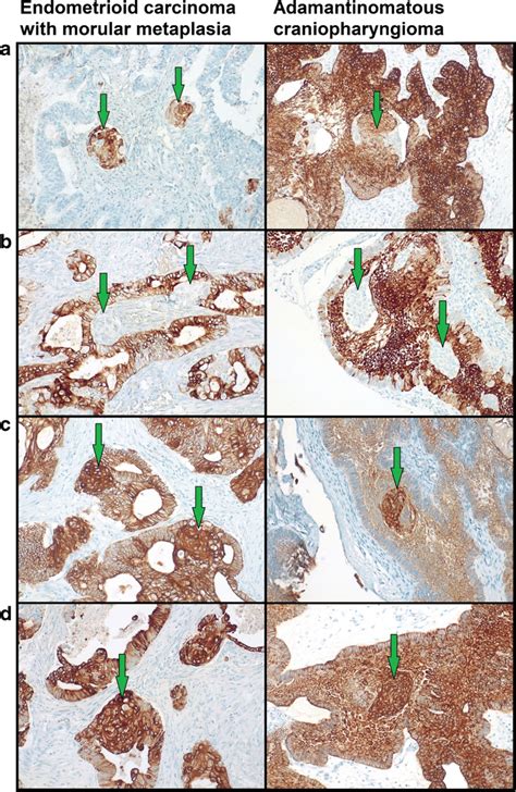 Cytokeratins CK Expression In Endometrioid Carcinomas With Morular