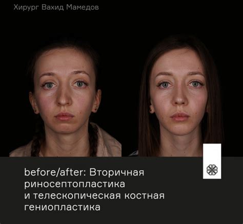 Омолаживающая ринопластика