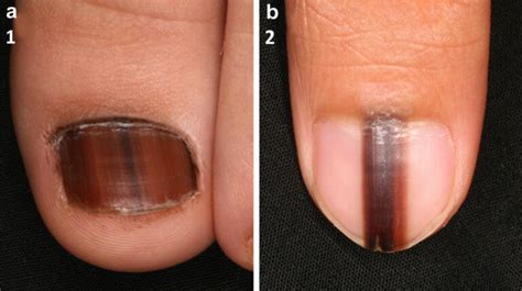 What Does Melanoma Look Like Under A Fingernail Symptoms And Pictures