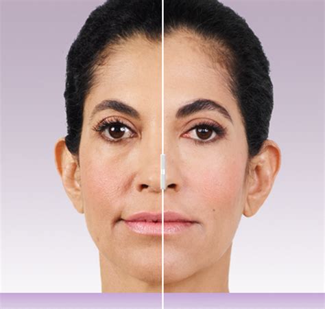 Juvederm Cincinnati - Juvederm Ultra Plus XC Cincinnati