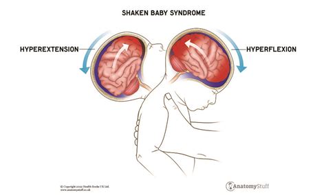 Shaken Baby Syndrome The Symptoms Impact Of Shaken Baby