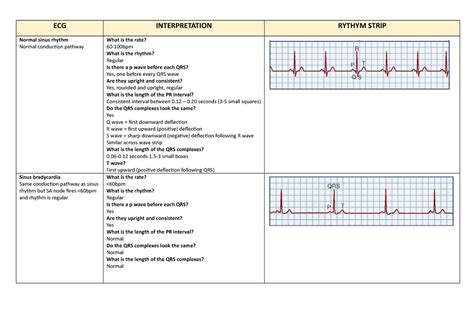 ECG rhythms and interpretation - ECG INTERPRETATION RYTHYM STRIP Normal ...