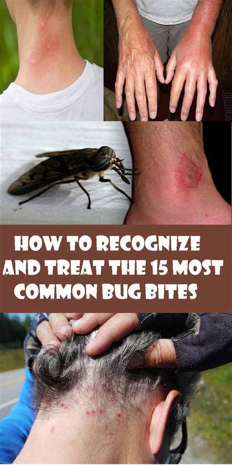 How To Recognize And Treat The 15 Most Common Bug Bites Bug Bites Intense Itching Body