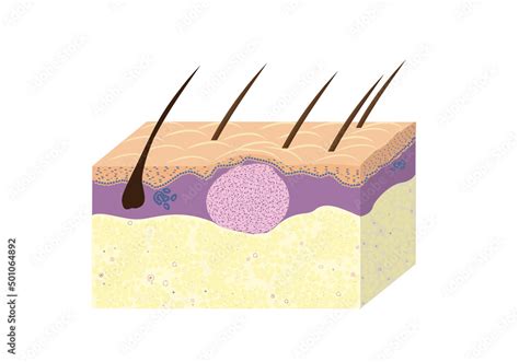 Scheme Of Skin Fibroma Histology Vetcor Stock Vector Adobe Stock