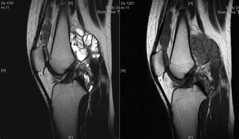 A Case Series Of Intra Articular Diffuse Pigmented Villonodular